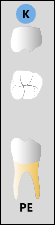 Odontogram tooth image showing the PE letters underneath the tooth.